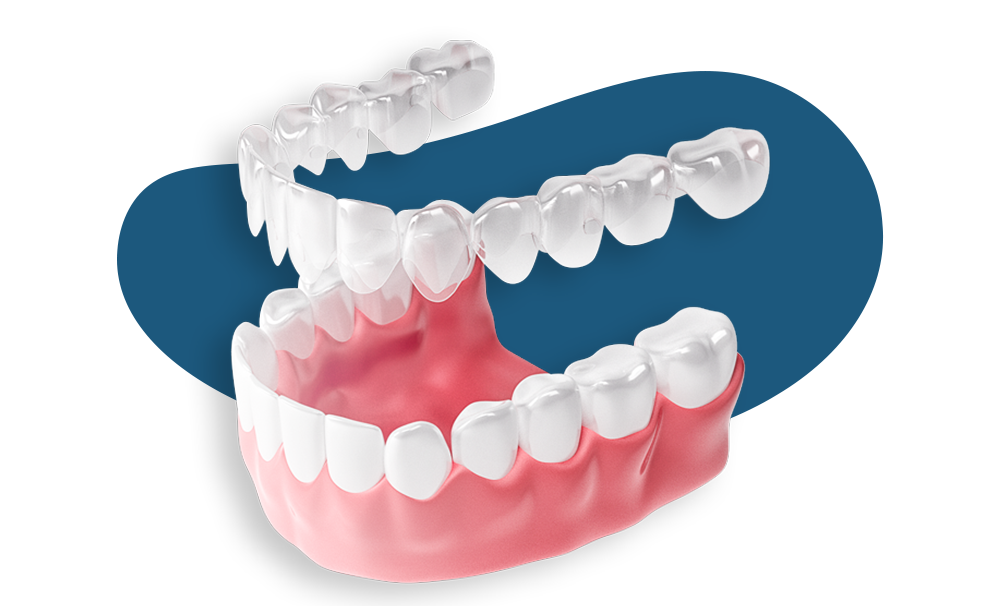 Invisalign Aligners @ Asian Dental